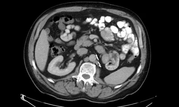 Una vacuna experimental logra frenar la recaída en cáncer de riñón avanzado