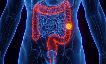 Una nueva herramienta médica puede anticipar el riesgo de cáncer de colon temprano