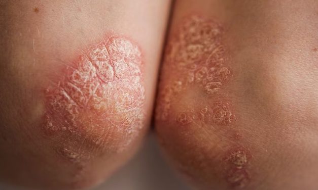 La grasa abdominal está relacionada con la psoriasis