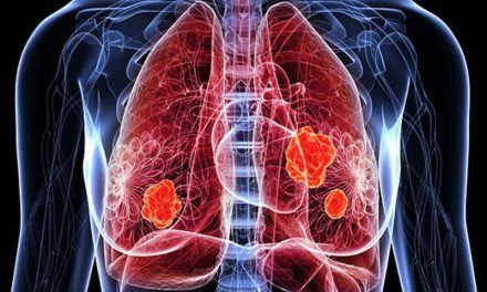 La sencilla prueba que puedes hacer con tus pulgares para comprobar si podrías tener cáncer de pulmón