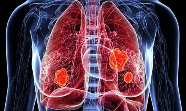 La sencilla prueba que puedes hacer con tus pulgares para comprobar si podrías tener cáncer de pulmón