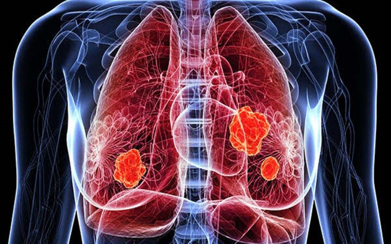 La sencilla prueba que puedes hacer con tus pulgares para comprobar si podrías tener cáncer de pulmón