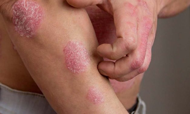 Tener grasa en esta parte del cuerpo multiplica las probabilidades de padecer psoriasis