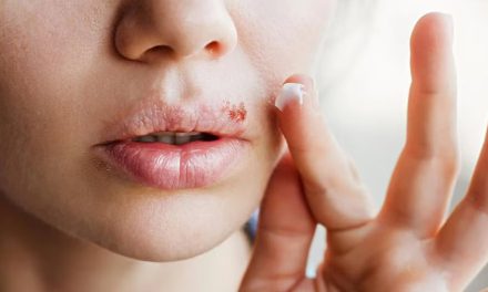 Descubren un vínculo entre el herpes labial y el riesgo de sufrir Alzheimer