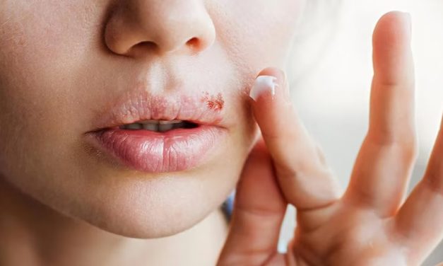 Descubren un vínculo entre el herpes labial y el riesgo de sufrir Alzheimer