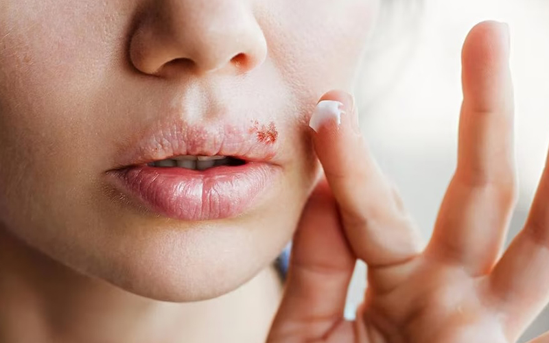 Descubren un vínculo entre el herpes labial y el riesgo de sufrir Alzheimer